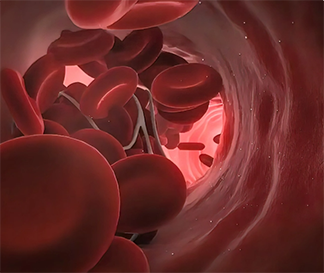 From theory to practice: Patients with deep vein thrombosis and multiple myeloma