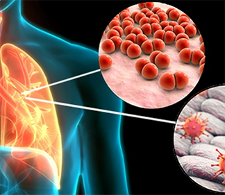 Managing pneumonitis in Immune Checkpoint Inhibitor-treated patients in times of COVID-19