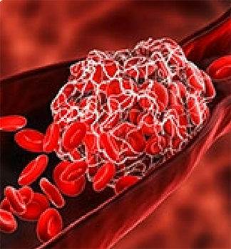 SARS-CoV-2 thrombotic events & vaccine induced thrombotic thrombocytopenia