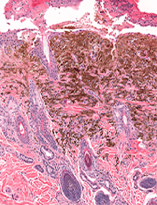 Treating cancer-associated thrombosis:  the past, present & future