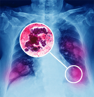 Immunotherapy treatment duration - Experience in NSCLC